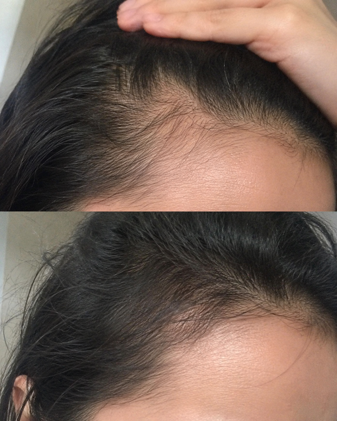 Before and after style close-up photos of a dark hairline