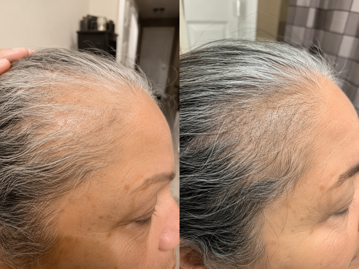 Side-by-side close-up photos of a gray hairline comparison