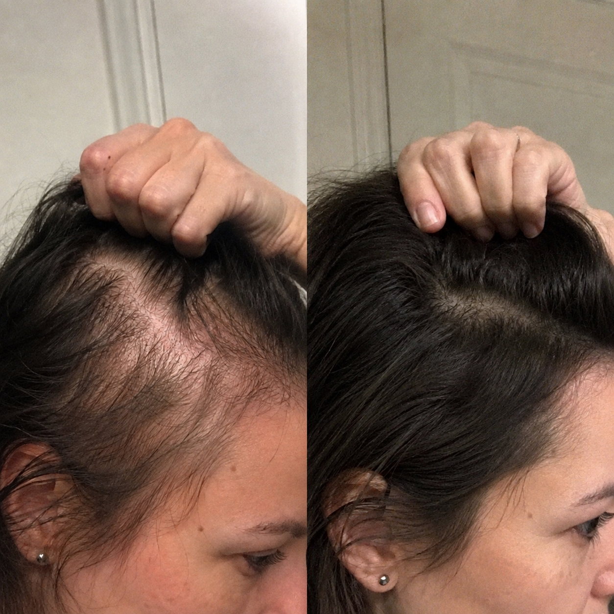 Side-by-side close-up photos focused on a woman's hairline and temple area